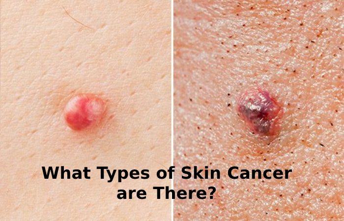 Types of Skin Cancer