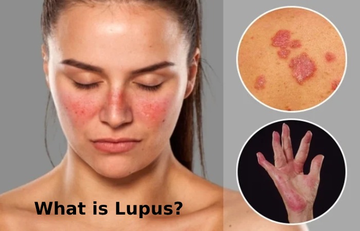 What is Lupus