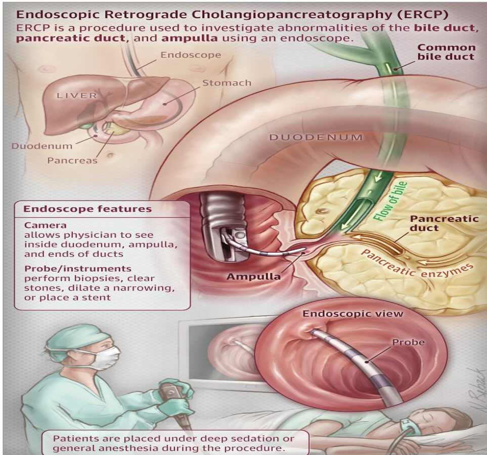ercp procedure bile duct endoscopy