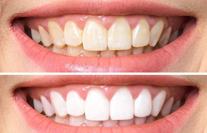 chisel dental cosmetic dentistry smile transformation bangalore