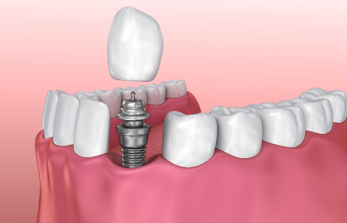 chisel dental implant nobel biocare bangalore