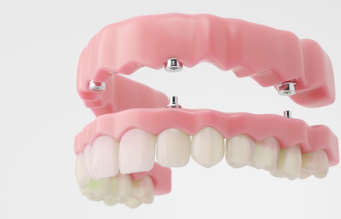 straumann-megagen-astratech-implant-brands-helvetic-clinics-budapest