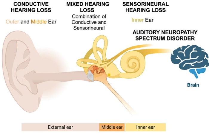 types of hearing loss india sensorineural conductive